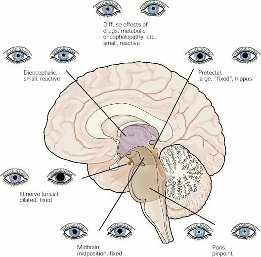 damage to midbrain casue fixed dilated pupil