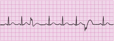 Demystifying ventricular arrhythmias