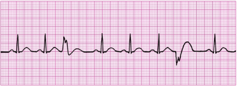 Demystifying ventricular arrhythmias