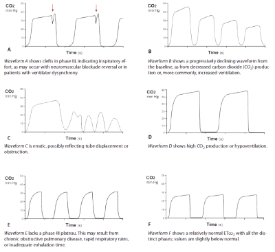 Understanding end-tidal CO2 monitoring