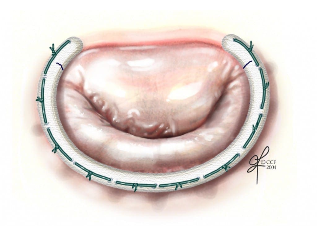 Mitral Valve Repair: A New Choice