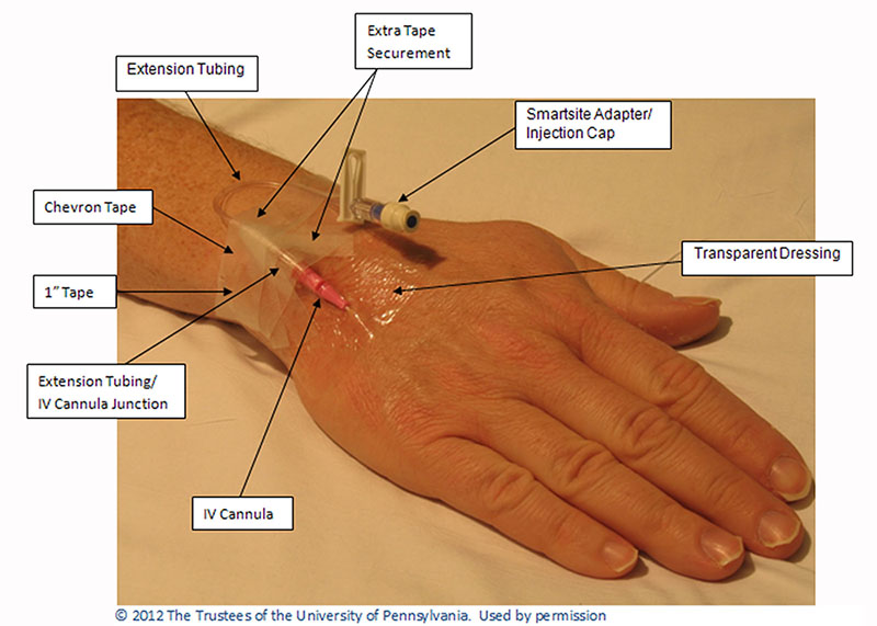 intravenous line