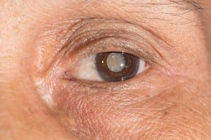 Mature cataract with painless clouding of lens 