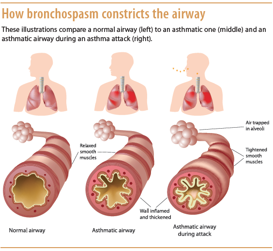 pathological changes in bronchial asthma