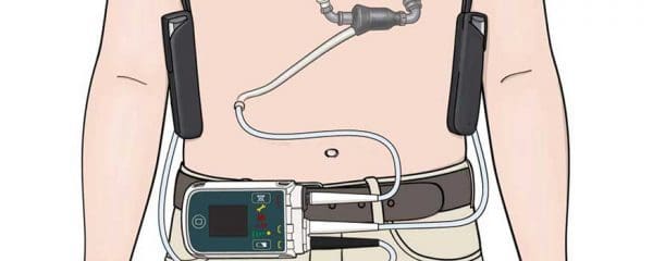 Caring for patients with a left ventricular assist device