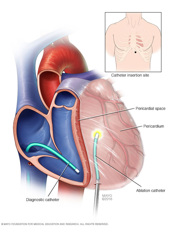 Ablation Of AF Improves QOL More Than Drugs American Nurse Today