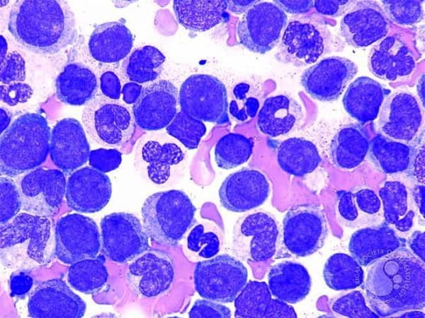 Fda Approves New Drug For Acute Myeloid Leukemia - American Nurse Today