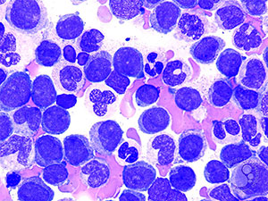 FDA approves new drug for acute myeloid leukemia - American Nurse Today