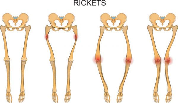 FDA approves new drug for rare form of rickets - American Nurse Today