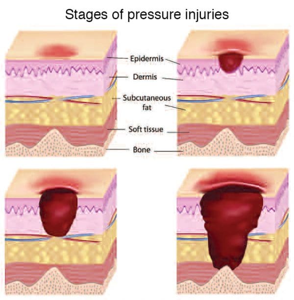 Critical care of the skin - American Nurse Today