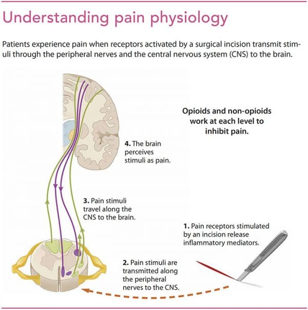 Opioid and non-opioid analgesia during surgery - American Nurse