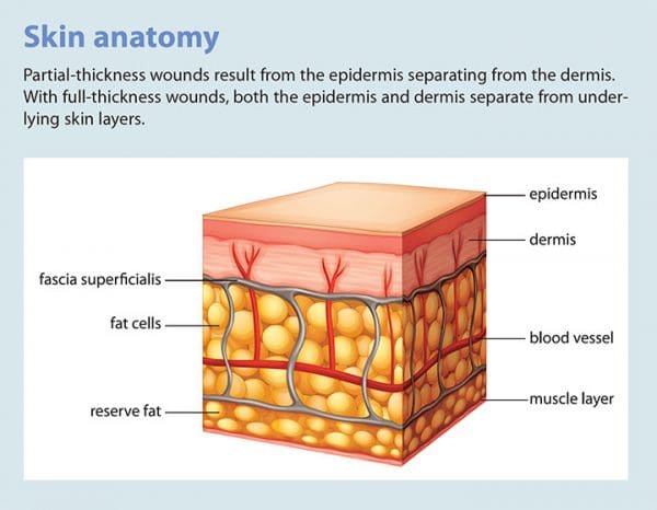 STAMP out skin tears: Skin tear assessment, management, and prevention