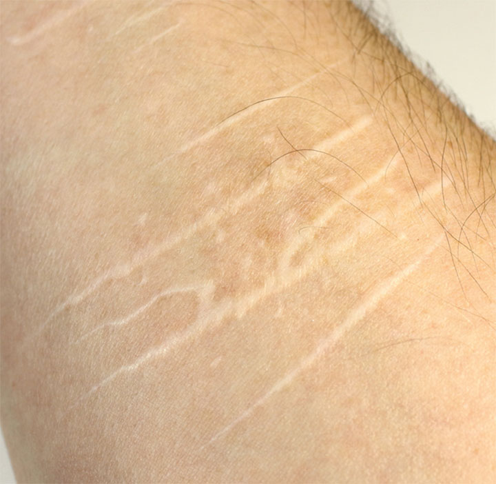 Badly Scarred Upper Arm From Self Mutilation By Cutting Stock