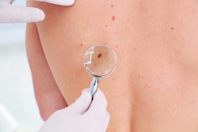 melanoma mitigation the key to higher survival rates