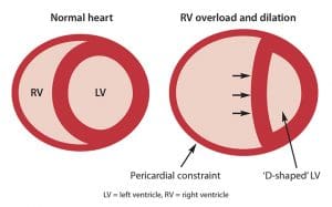 Right-sided heart failure: often overlooked, crucial for understanding