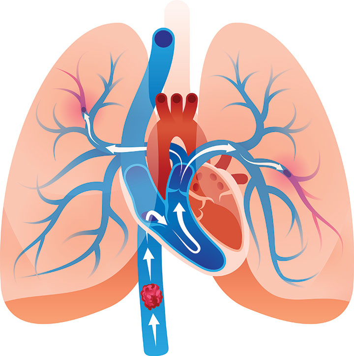 Pulmonary Embolism Surveillance Is Key