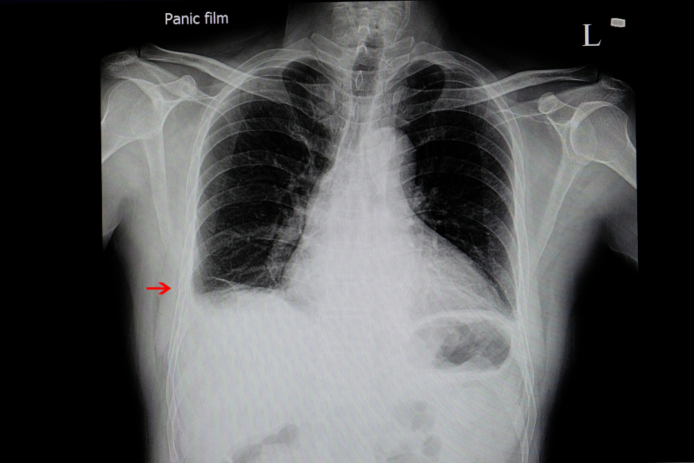 Pneumothorax & Haemothorax | PPT